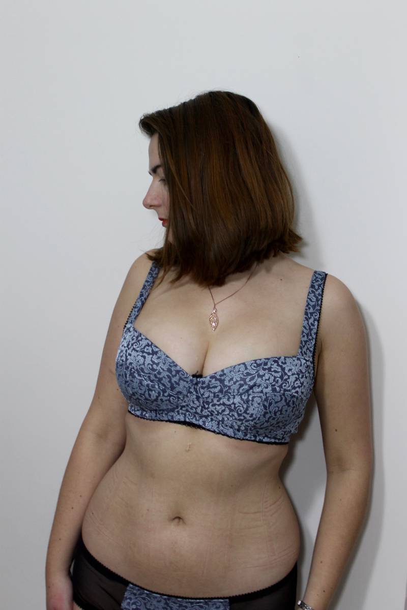 Boylston bra with wires removed