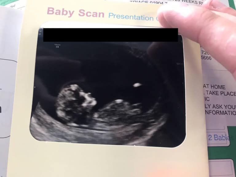 Blogger 12 week pregnancy scan